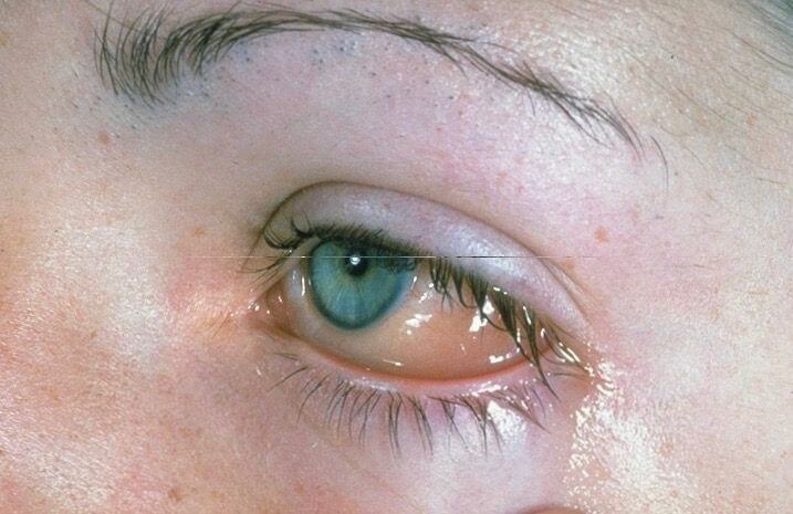allergische Konjuntivitis
