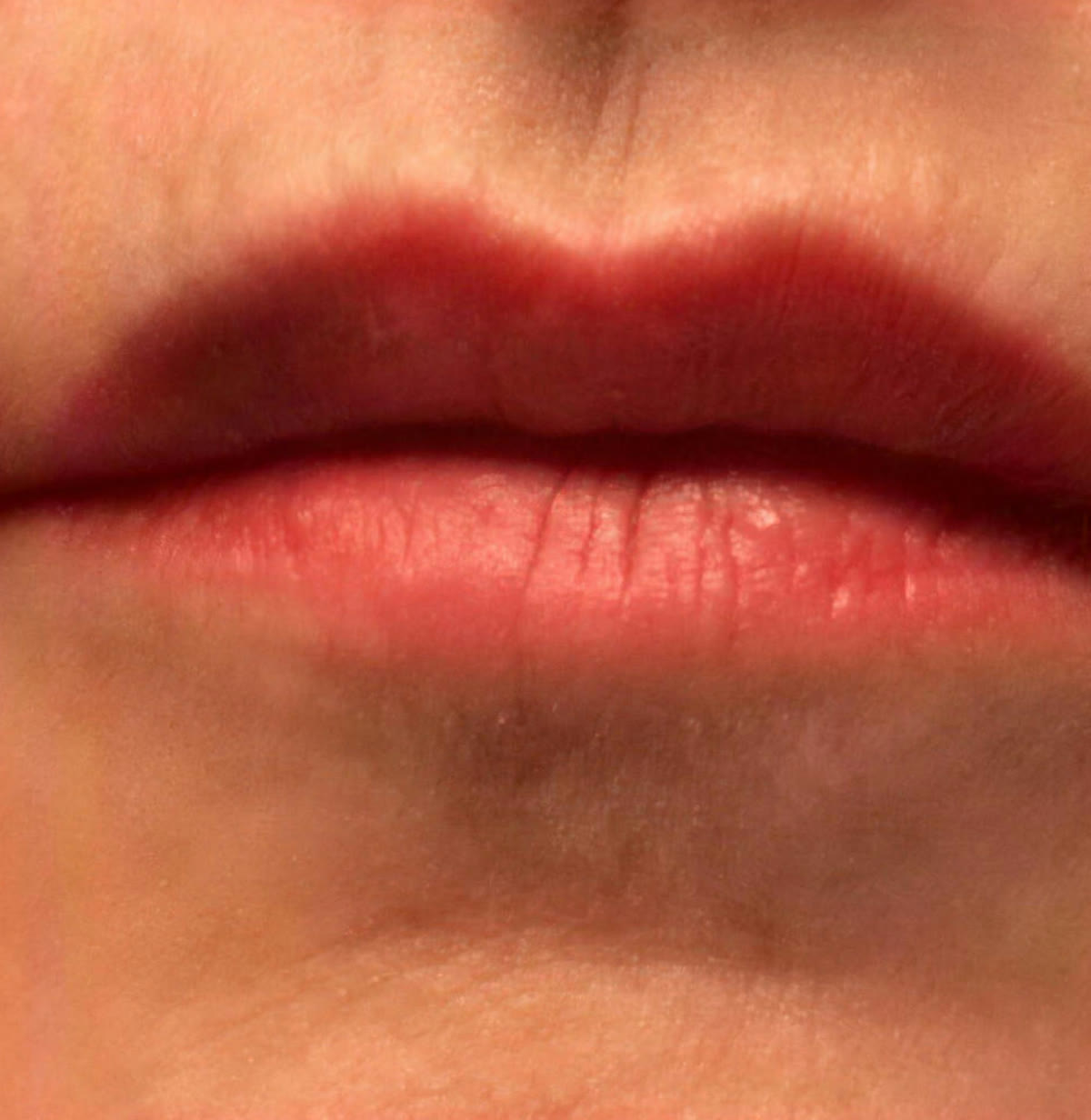 Lippenkontur und Volumen – nachher
